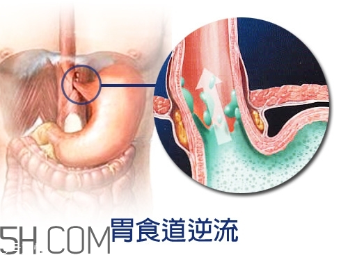 胃食道逆流怎么辦 質子泵抑制劑風險高