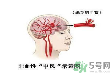 腦中風的護理措施？腦中風的飲食護理？