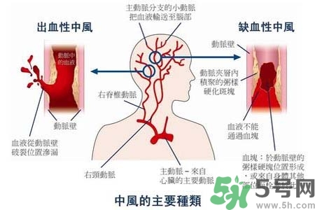 腦中風的發病因素？腦中風的并發癥有哪些 ？