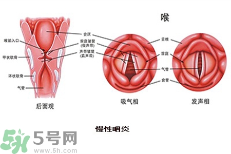 慢性咽炎是什么？慢性咽炎的癥狀有哪些？