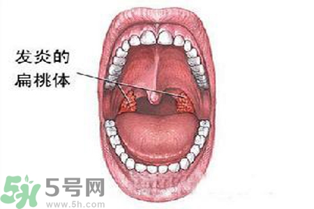 慢性咽炎是什么？慢性咽炎的癥狀有哪些？