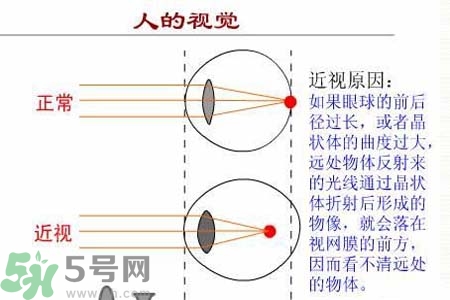 近視眼的發(fā)病因素？近視眼的并發(fā)癥有哪些？