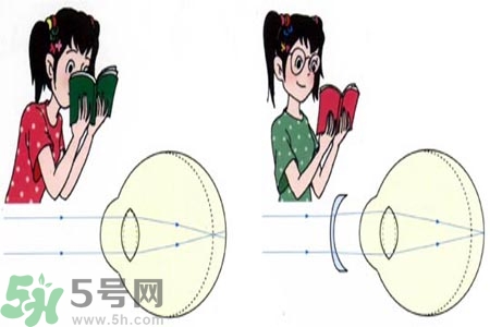 近視眼的發(fā)病因素？近視眼的并發(fā)癥有哪些？