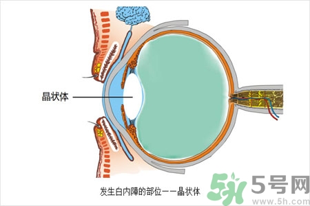 白內(nèi)障的護(hù)理措施是什么？白內(nèi)障的飲食護(hù)理有哪些？