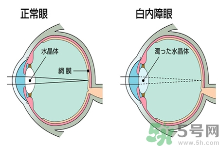 白內(nèi)障治療方法是什么？白內(nèi)障可以用什么藥物治療？