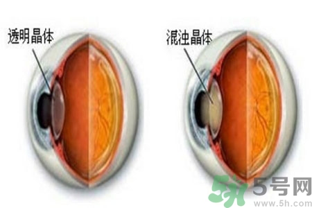 白內(nèi)障治療方法是什么？白內(nèi)障可以用什么藥物治療？