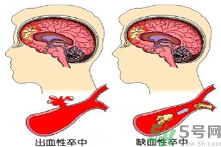 腦出血的治療方法是什么？腦出血可以用哪些藥物治療？