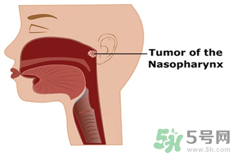 鼻咽癌的日常措施是什么？鼻咽癌注意的飲食有哪些？
