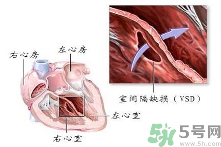 先天性心臟病是什么？先天性心臟病的癥狀有哪些？