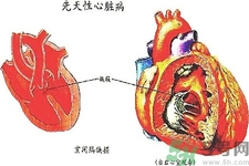 先天性心臟病發(fā)病原因是什么？