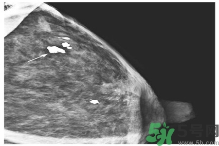 乳腺增生鈣化是什么？乳腺鈣化的癥狀有哪些？