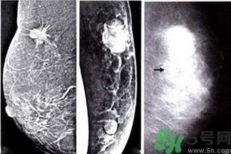 乳腺增生鈣化是什么？乳腺鈣化的癥狀有哪些？