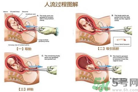 人工流產后多久可以再次懷孕？流產后需要注意什么？