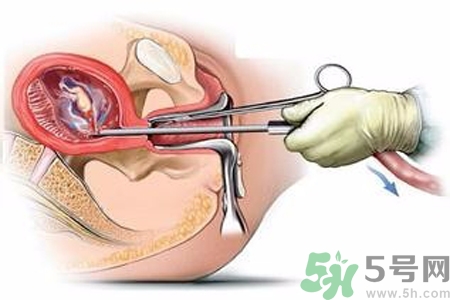 人工流產后多久可以再次懷孕？流產后需要注意什么？