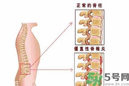 僵直性脊椎炎的癥狀有哪些？怎樣預(yù)防僵直性脊椎炎？