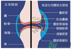 骨關(guān)節(jié)炎能治好嗎？骨關(guān)節(jié)炎平時注意事項