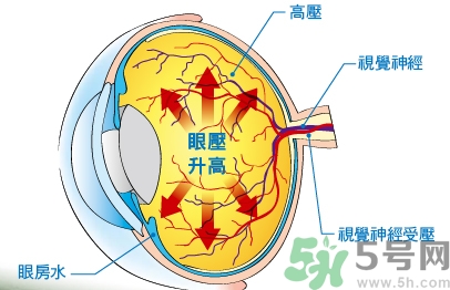 青光眼可以治愈嗎？青光眼怎樣治療？