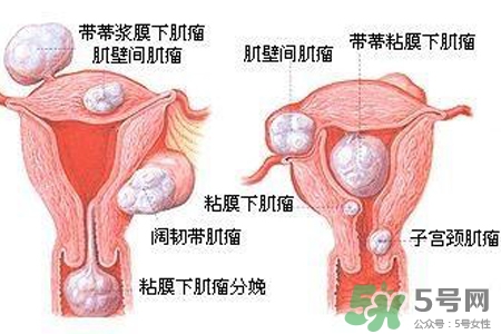 子宮小會影響生育嗎？子宮小會導(dǎo)致不孕嗎？