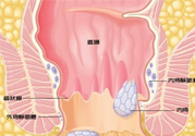 怎樣辨別外痔和內痔？外痔和內痔的區別