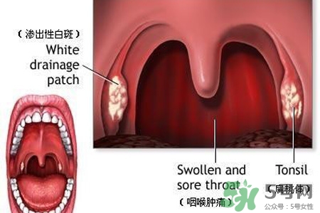 口含大蒜能治療咽炎嗎？巧用大蒜治療咽炎咳嗽