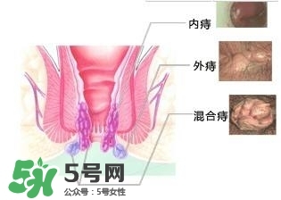 痔瘡吃什么藥效果好？痔瘡吃什么藥好得快？