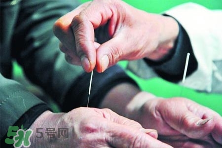 沒病可以針灸嗎？沒病可以扎針嗎？