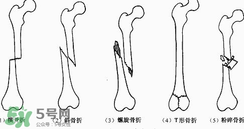 骨折吃什么好得快？骨折后注意事項