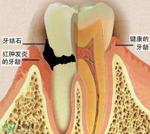 牙結石是什么？牙結石圖片