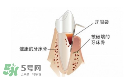 牙周炎怎么治療？牙周炎怎么治好