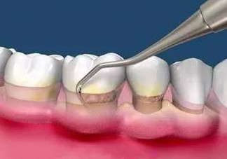 牙周炎怎么治療效果最好？牙周炎怎么治療小偏方