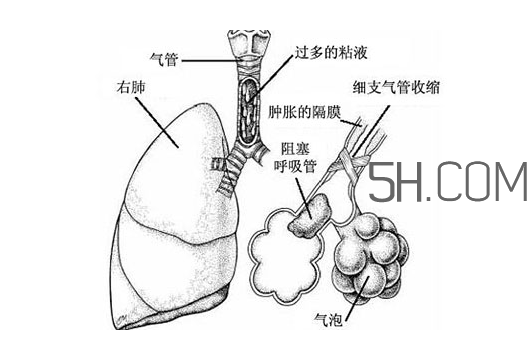 哮喘是怎么引起的?哮喘是什么感覺?