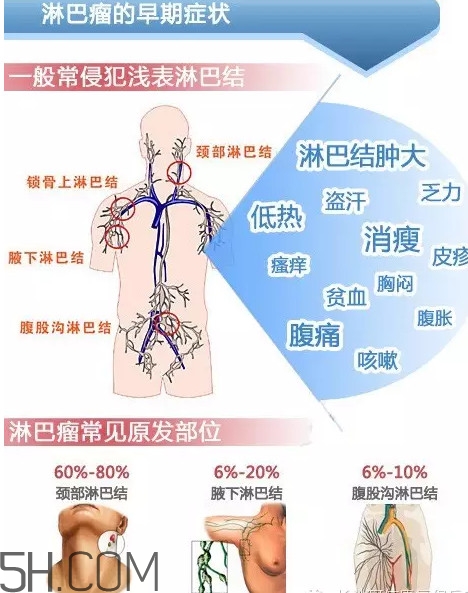 淋巴癌是怎么回事？淋巴癌如何診斷