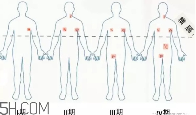 淋巴癌是怎么回事？淋巴癌如何診斷