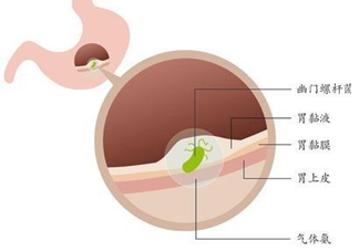 幽門螺桿菌的癥狀有哪些表現？幽門螺旋菌怎么治療