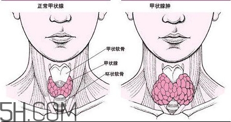 甲狀腺結節與甲狀腺腫瘤的區別有哪些？甲狀腺結節可以艾灸嗎