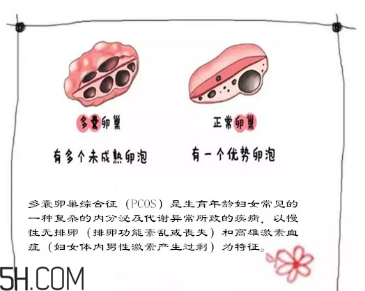 多囊卵巢生不了？多囊卵巢懷孕要看準時間