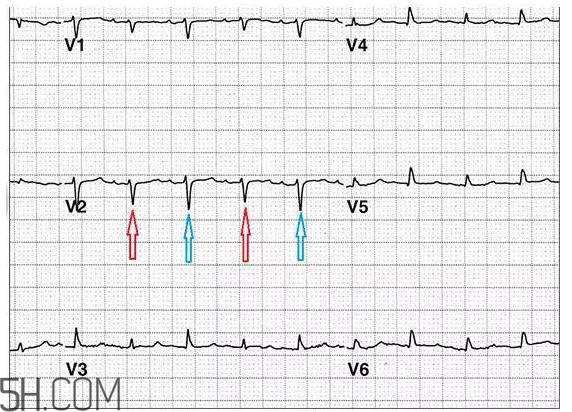 心電圖怎么看？6種常見心電圖異常情況