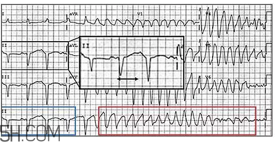 心電圖怎么看？6種常見心電圖異常情況