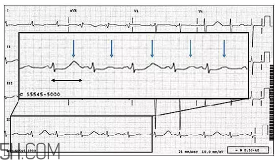 心電圖怎么看？6種常見心電圖異常情況