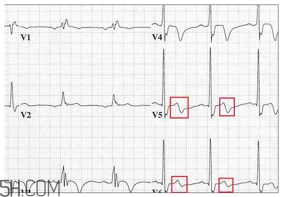 心電圖怎么看？6種常見心電圖異常情況
