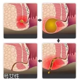 肛瘺非手術治療才可以嗎？手術是治療的關鍵途徑