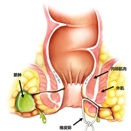 肛瘺非手術治療才可以嗎？手術是治療的關鍵途徑