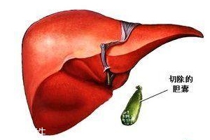 膽囊為什么容易長結石？與個體因素密切相關