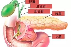 膽囊結石能用排石藥嗎?排出的石頭并非膽結石