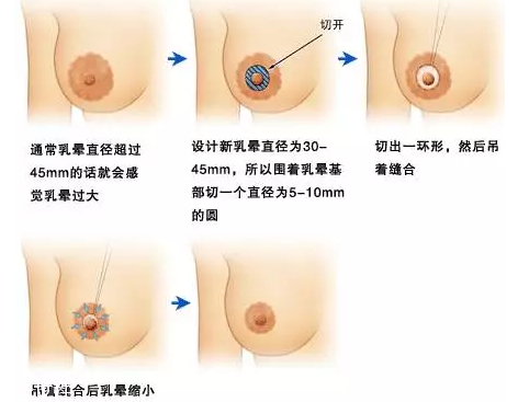 乳暈縮小術怎么做？乳暈縮小術知識全解