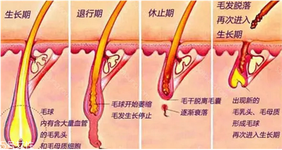 超冰脫毛需要注意什么 超冰脫毛的優勢