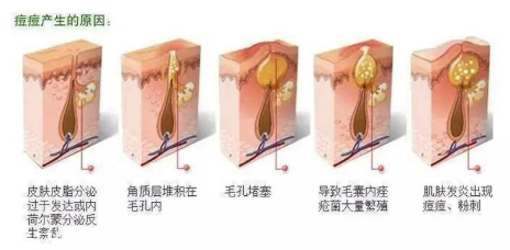 頑固痘痘怎么消除？油皮為什么反復爆痘？