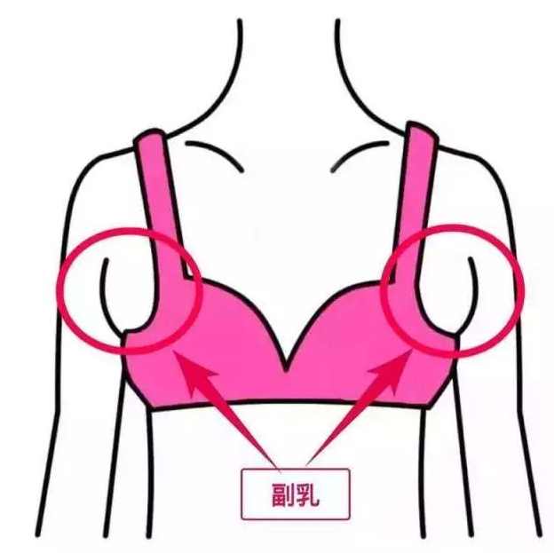 假副乳怎么形成的 3個不良習慣