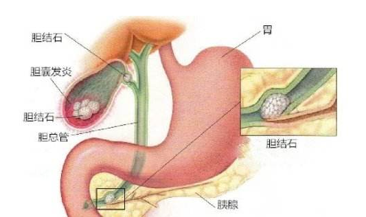 膽結石的食療方法 如何預防膽結石