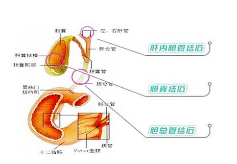 膽結石的食療方法 如何預防膽結石